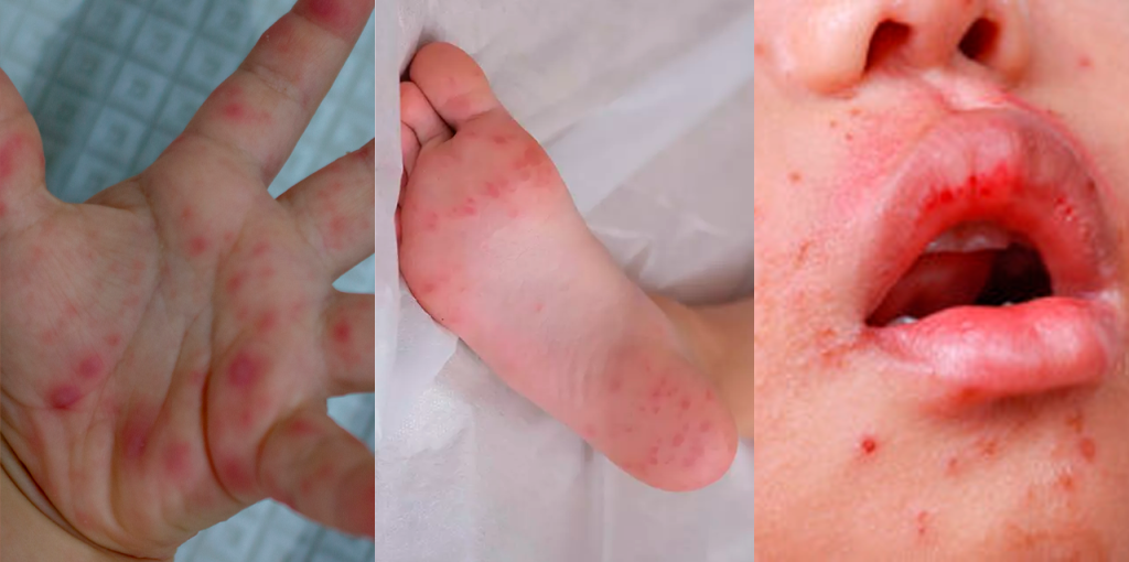 brote del virus enfermedad